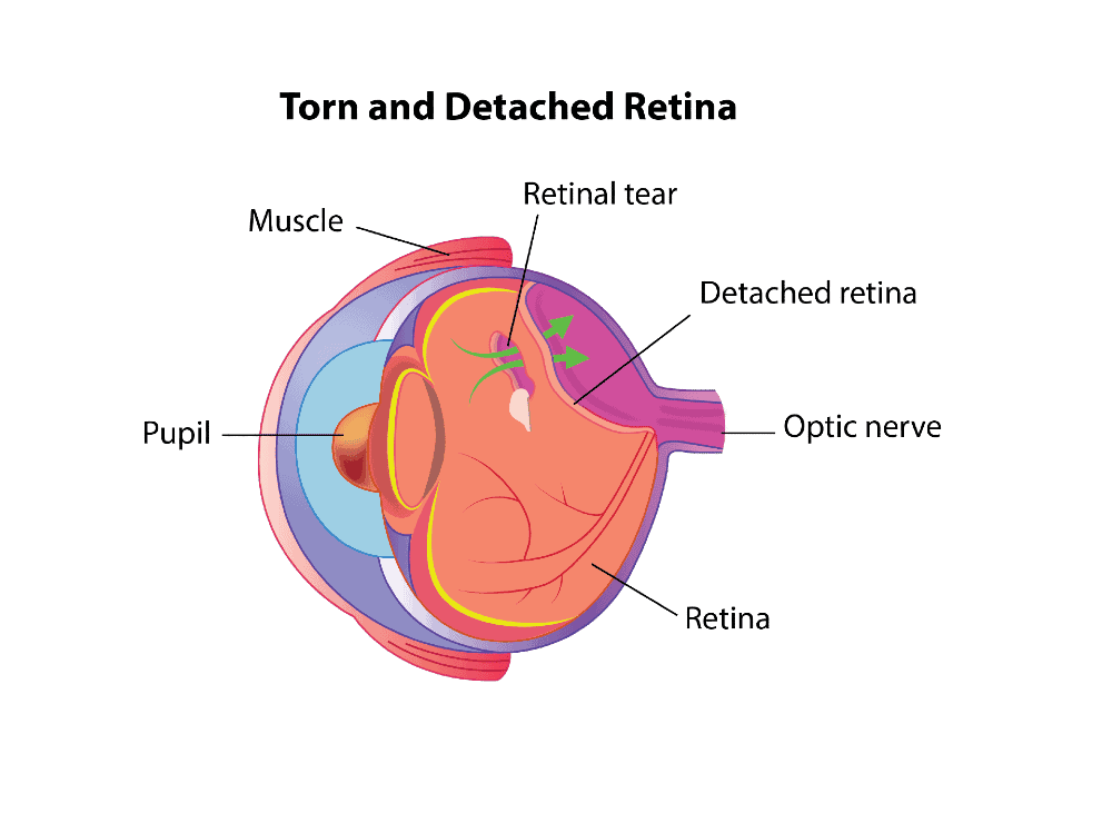 Retinal tears and detachment (1)