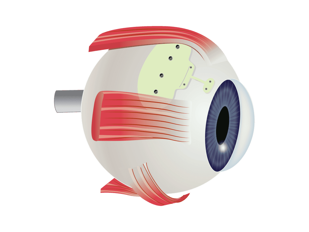 Illustration of an eye with glaucoma tube implant