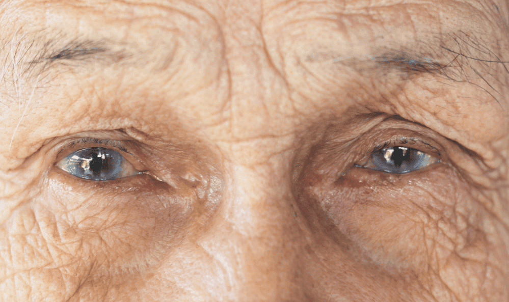 Patient suffering from Cataract