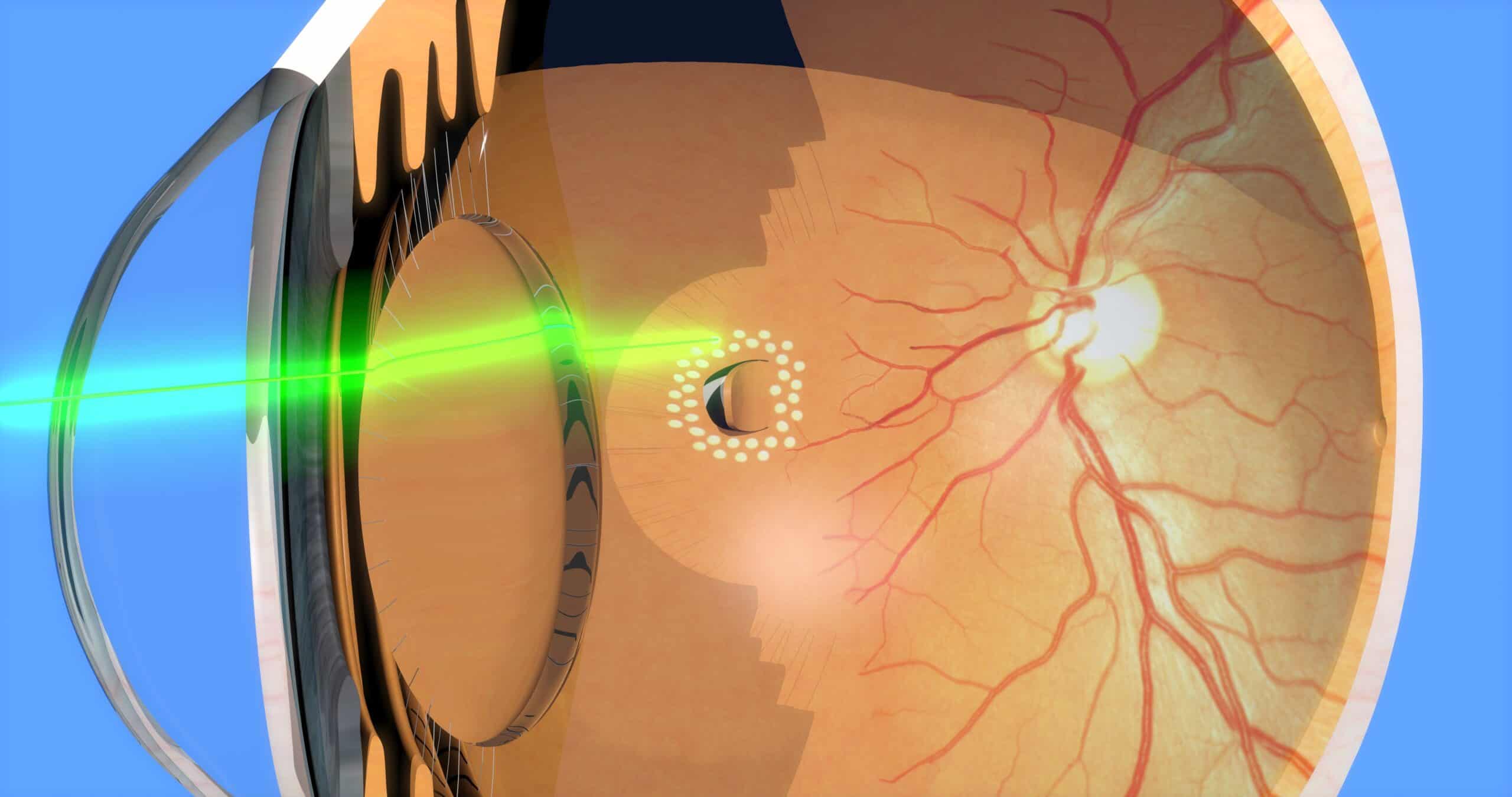 Retinal laser