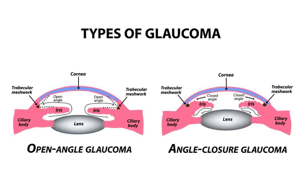 Types of glaucoma, close and open angle glaucoma
