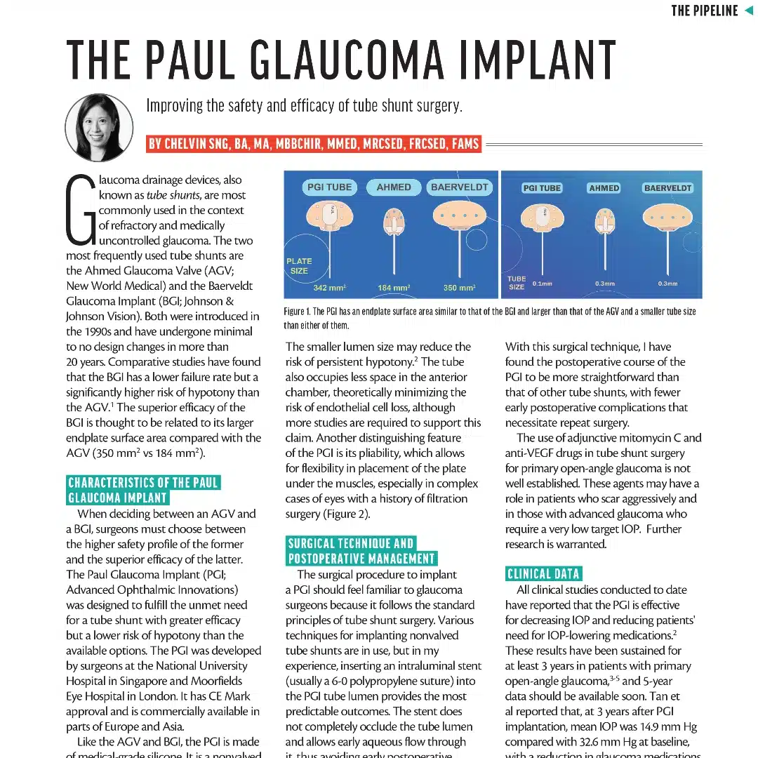 The Pipeline: The Paul Glaucoma Implant pdf